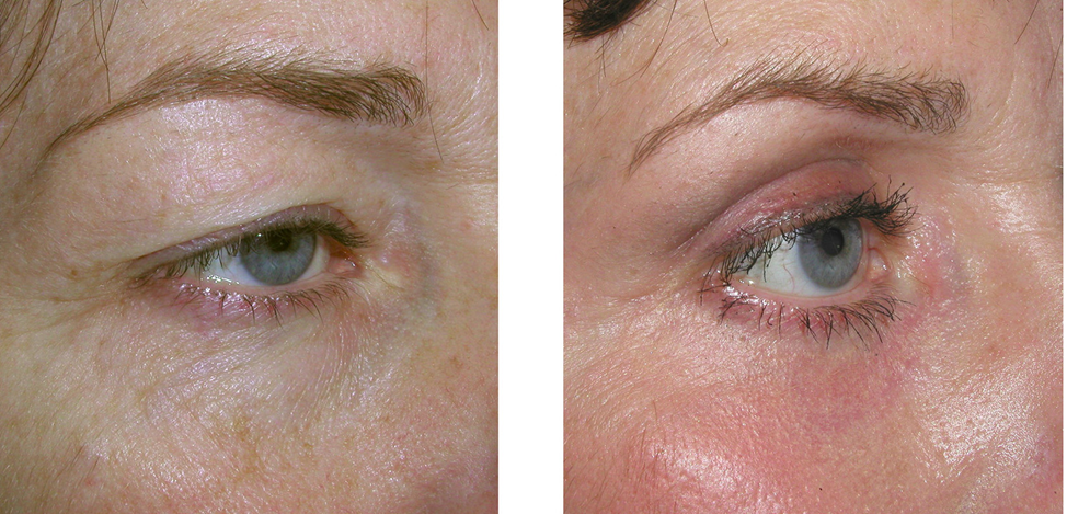 Лазерное омоложение лица: фото до и после