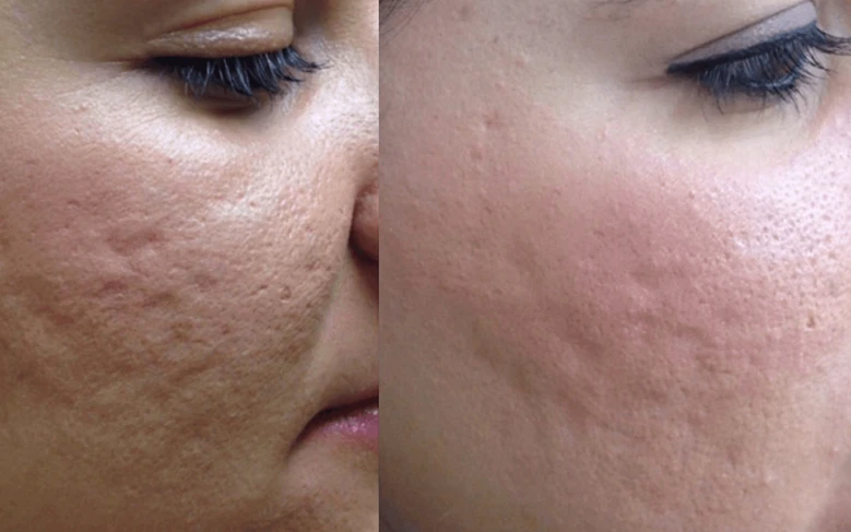 Фракционное омоложение