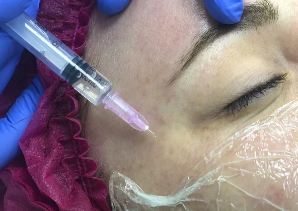 Мезотерапия, биоревитализация