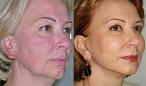 Нитевой лифтинг – мезонити для подтяжки лица