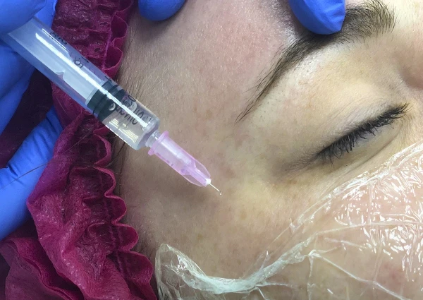 Мезотерапия, биоревитализация