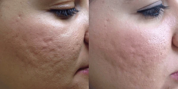 Фракционное омоложение