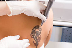 Удаление татуажа и татуировок